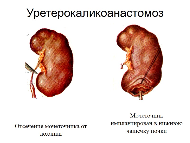 Уретерокаликоанастомоз  Отсечение мочеточника от лоханки Мочеточник имплантирован в нижнюю чашечку почки
